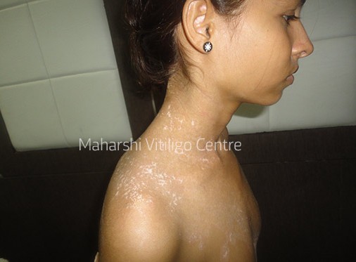Vitiligo Centre Indore - After