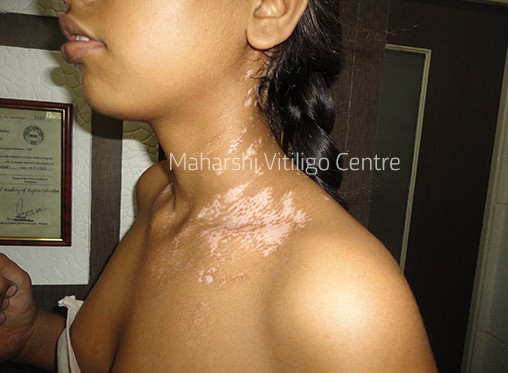Vitiligo Centre Indore - After