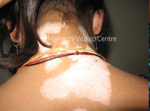 Vitiligo Centre Indore - Before