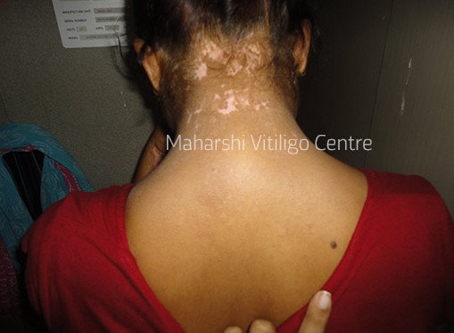 Vitiligo Centre Indore - After