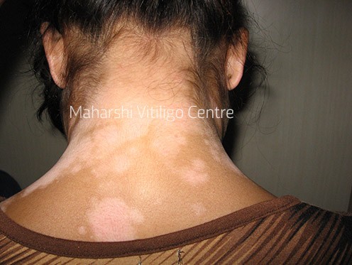 Vitiligo Centre Indore - Before
