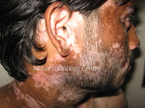 Vitiligo Centre Indore - Before