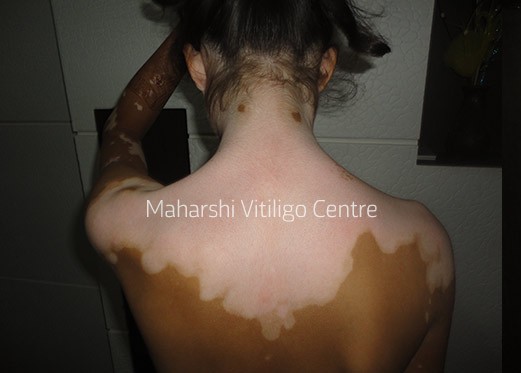 Vitiligo Centre Indore - Before