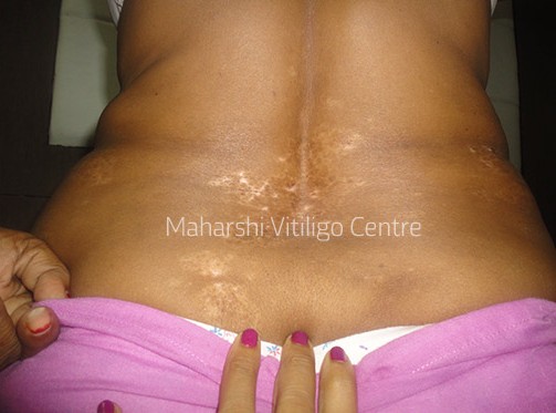 Vitiligo Centre Indore - After