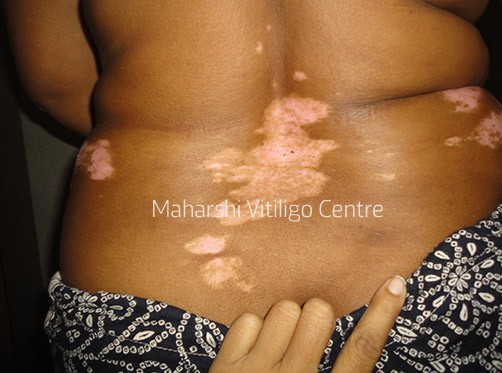 Vitiligo Centre Indore - Before