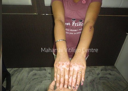 Vitiligo Centre Indore - After
