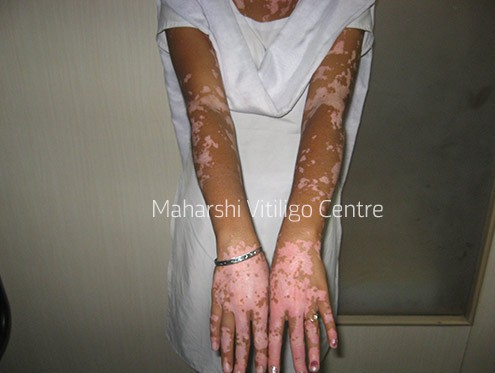 Vitiligo Centre Indore - Before