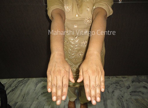 Vitiligo Centre Indore - After