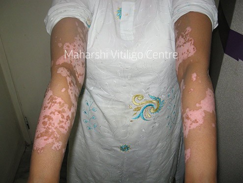 Vitiligo Centre Indore - Before