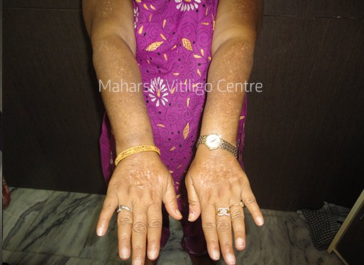 Vitiligo Centre Indore - After