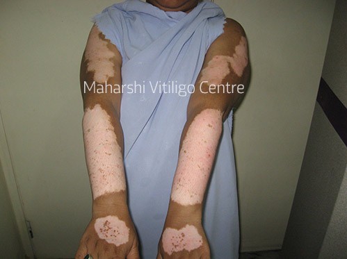 Vitiligo Centre Indore - Before