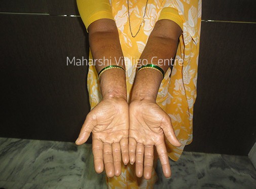 Vitiligo Centre Indore - After