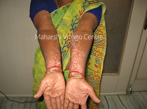 Vitiligo Centre Indore - Before