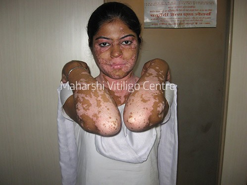 Vitiligo Centre Indore - Before
