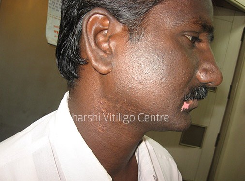Vitiligo Centre Indore - After