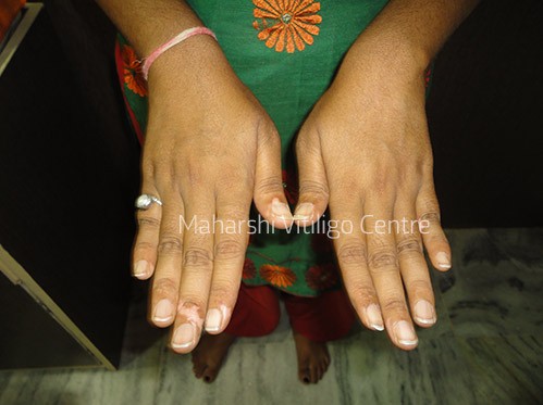 Vitiligo Centre Indore - Before