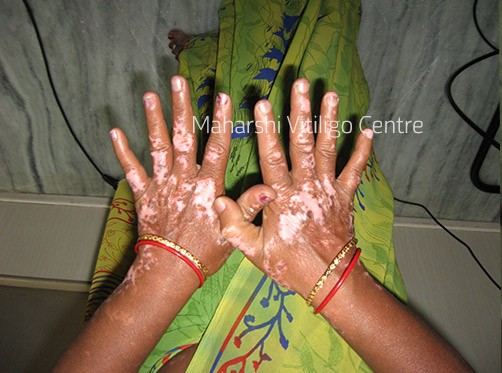 Vitiligo Centre Indore - Before