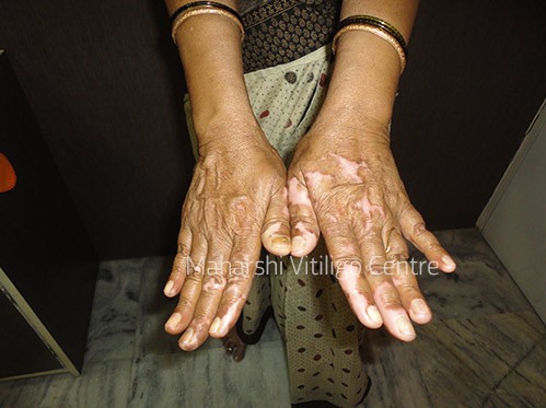 Vitiligo Centre Indore - After