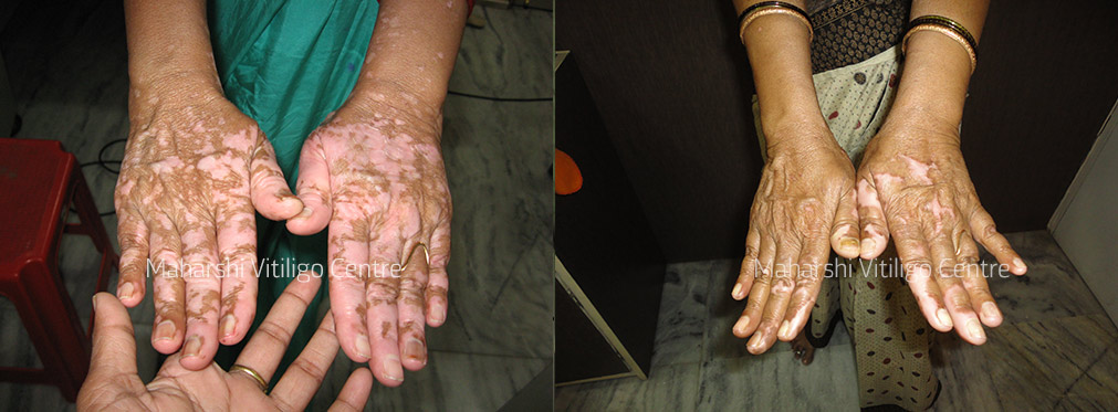 Vitiligo Centre Indore - Before