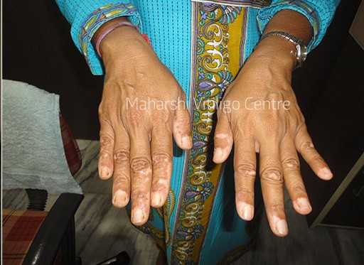 Vitiligo Centre Indore - After