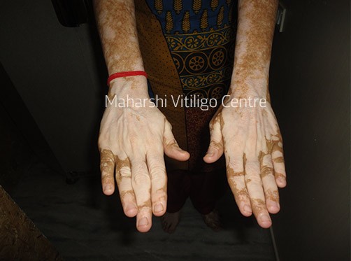 Vitiligo Centre Indore - Before