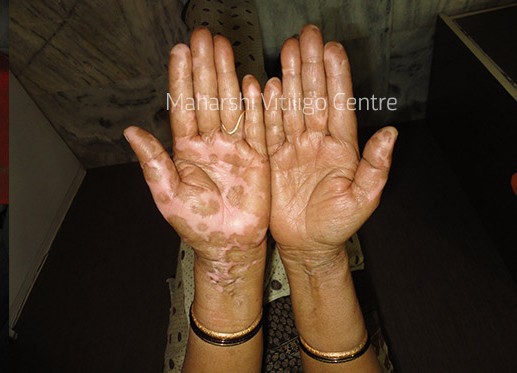 Vitiligo Centre Indore - After