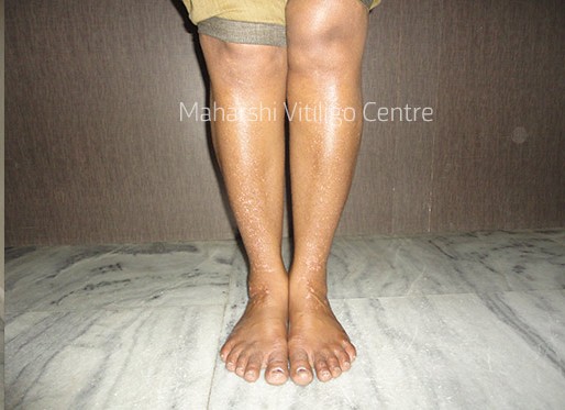 Vitiligo Centre Indore - After