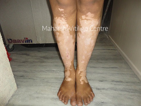 Vitiligo Centre Indore - Before