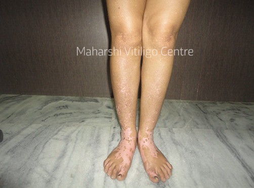 Vitiligo Centre Indore - After