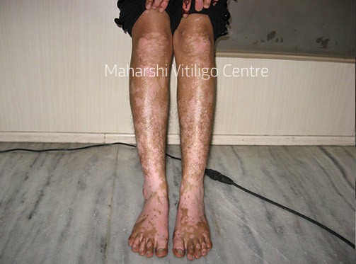 Vitiligo Centre Indore - Before