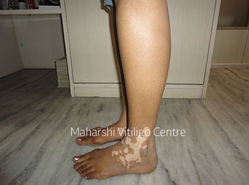 Vitiligo Centre Indore - Before
