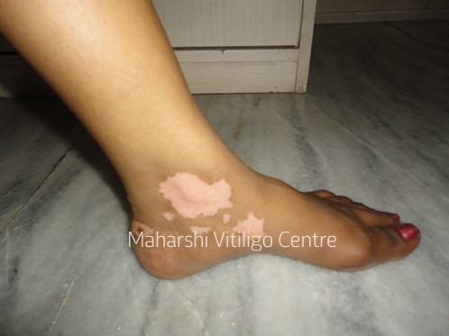 Vitiligo Centre Indore - Before