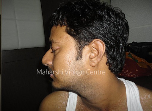 Vitiligo Centre Indore - After