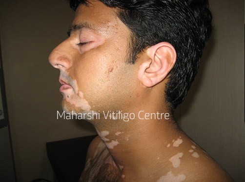 Vitiligo Centre Indore - Before