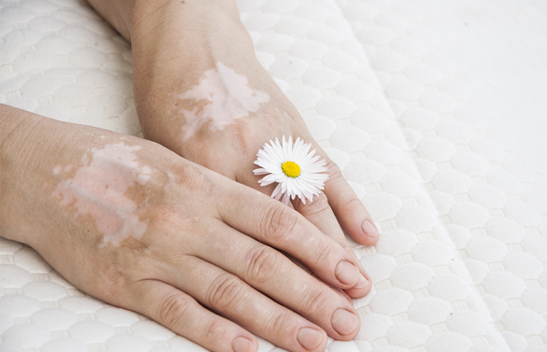 Complete management of vitiligo in a whole