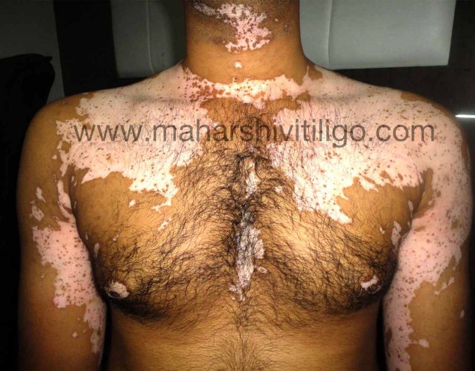 Vitiligo-Treatment-in-Mumbai