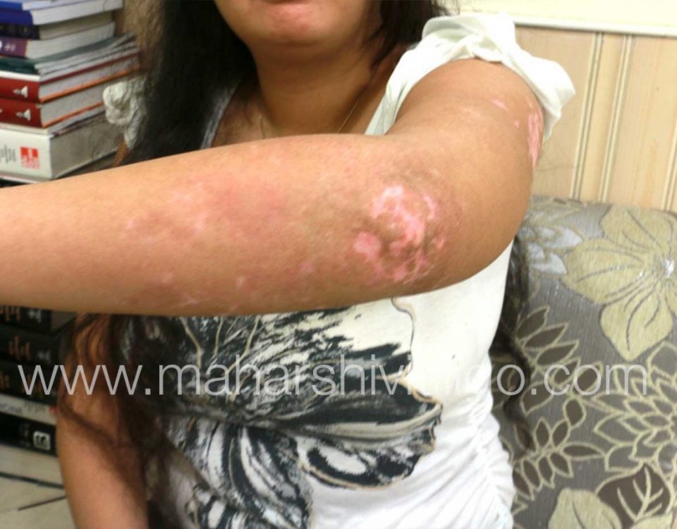 Vitiligo Treatment in Mumbai - After