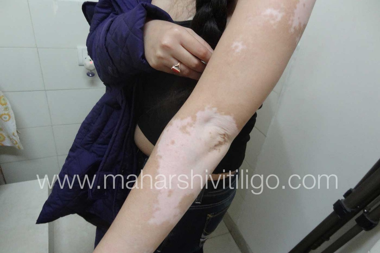 Vitiligo Treatment in Mumbai - Before