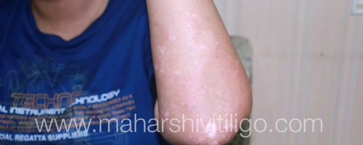 Vitiligo treatment result -After patient from Delhi